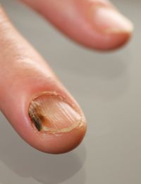 Nagelpilz Erkennen Und Vorbeugen So Geht S Sat 1 Ratgeber